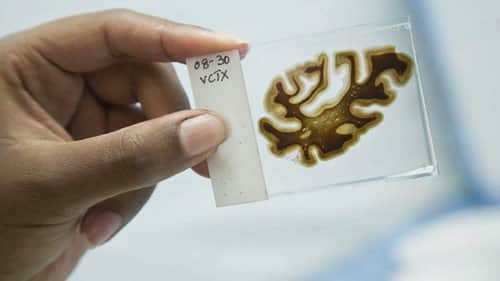 The Alzheimer's Project: Momentum in Science (Part 2)